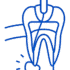 Root Canal Treatment