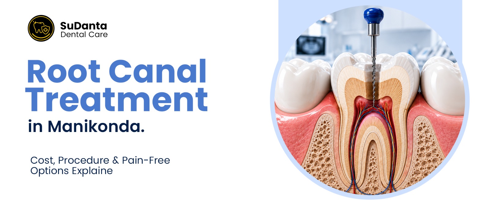 Root Canal Treatment in Manikonda