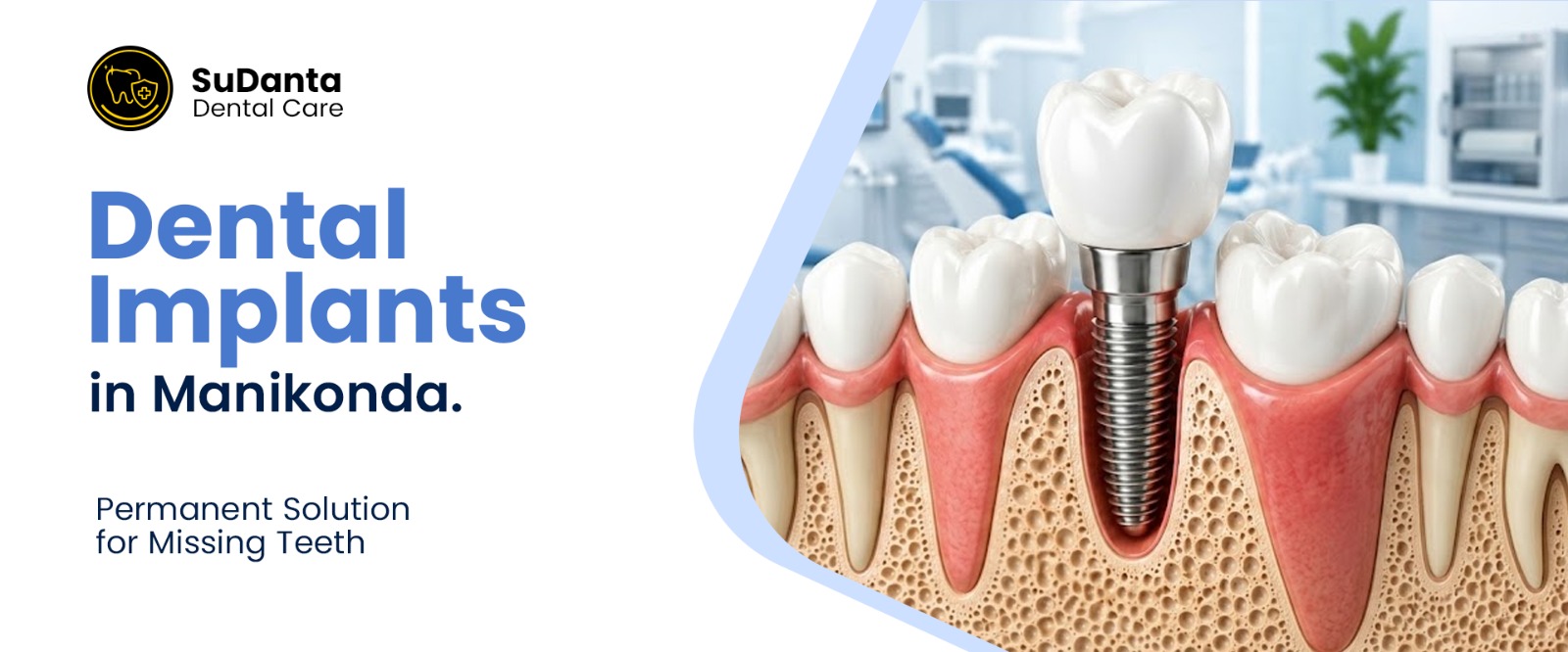 dental implants in Manikonda