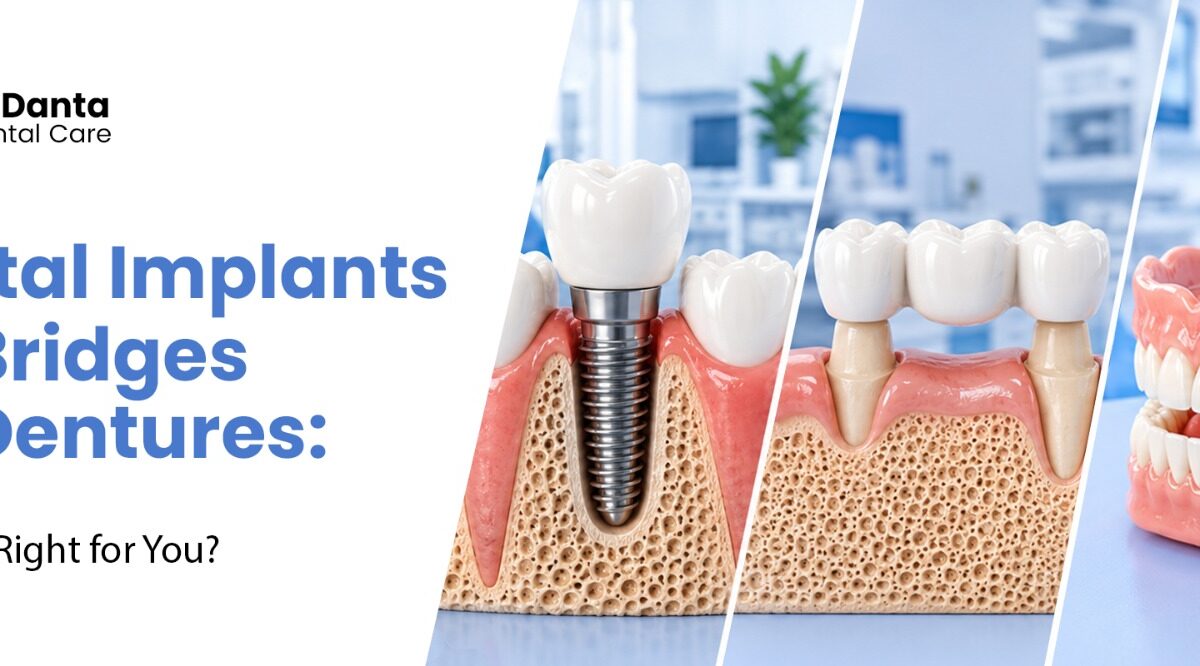 dental implants vs bridges vs dentures