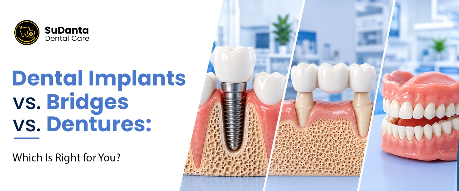 dental implants vs bridges vs dentures