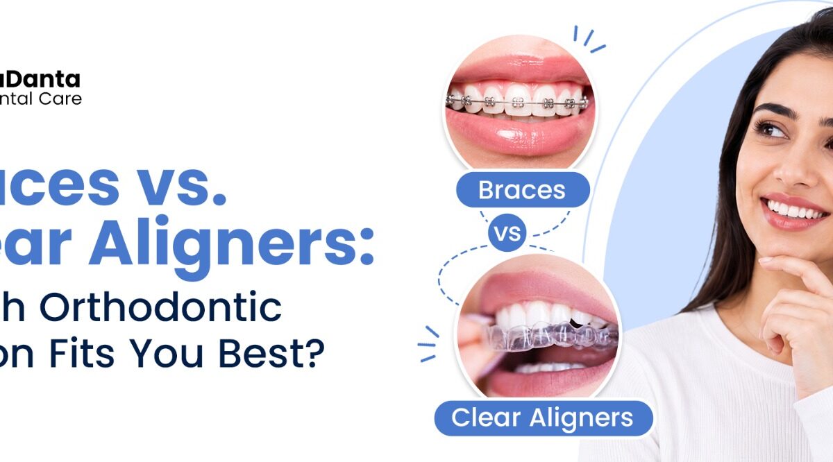 braces vs clear aligners